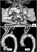 CTA images. CTA of the vertebro-basilar artery suggested terminated right VA (upper). A fenestrated stent graft well preserved antegrade blood flow into LSA as well as LCC (lower). Lt. VA, left vertebral artery; BA, basilar artery.