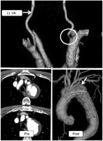 CTA and CT images. CTA of the vertebral artery revealed stenotic orifice (white circle) of right VA (upper). A fenestrated stent graft well preserved antegrade blood flow into LSA as well as LCC (lower). Postoperative CTA shows complete thrombo-occlusion of distal aortic arch aneurysm (lower, white arrow). Lt. VA, left vertebral artery.