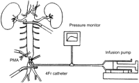 Experimental model. The abdominal aorta below the left renal artery and above the iliac bifurcation, and the posterior mesenteric artery were clamped for 30 min. Intra-aortic infusion of isotonic sodium chloride solution with or without ONO-5046 was performed for the first 3 min.