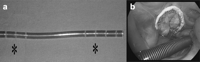 (a) The Remote Access Perfusion™ venous cannula is a double stage cannula ideated to simultaneously drain the superior and inferior vena cava. To obtain an optimal performance of the cannula, the distal perforated parts (*) must be positioned in both the superior and inferior vena cava. (b) Intraoperative view: the non-perforated segment of the cannula crosses the right atrium without impeding the view of the tricuspid valve.