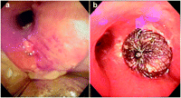 (a) Endobronchial view of bronchopleural fistula. (b) Endobronchial view of the deployed Amplatzer septal occluder device.