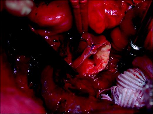 Puncher's hole in the posterior wall of the ascending aorta.