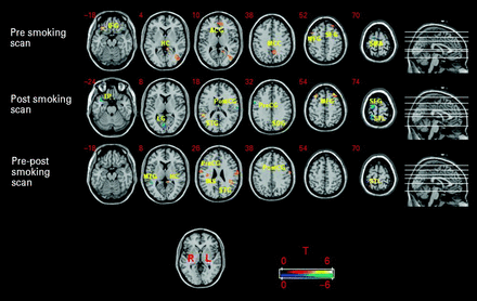 Areas of activation where cue reactivity during each scan session and between the pre- and post-smoking scans was significantly correlated with depression severity (HAMD). Activations in orange represent where cue reactivity was positively correlated whereas areas in blue represent negative correlations. During the pre-smoking scan HAMD was positively correlated with cue reactivity in inferior frontal gyrus (IFG), medial occipital lobe (MOL), middle frontal gyrus (MFG), hippocampus (HC), middle cingulate cortex (MCC), superior frontal gyrus (SFG), and anterior cingulate gyrus (ACG); and negatively correlated in supplementary motor area (SMA). During the post-smoking scan HAMD was positively correlated with cue reactivity in the MFG, superior temporal gyrus (STG), and superior occipital cortex (SOC); and negatively correlated in the superior parietal lobule (SPL), SFG, postcentral gyrus (PostCG), precentral gyrus (PreCG), lingual gyrus (LG), and temporal pole (TP). Differential cue reactivity between the pre-smoking and post-smoking scans was positively correlated with HAMD in the STG, PostCG, PreCG, hippocampus (HC), insula (INS), superior temporal lobe (STL), and fusiform gyrus (FG); and negatively correlated in the middle temporal gyrus (MTG). Numbers in the top left corner of each brain slice represent the z coordinate in MNI space. p≤0.005 (uncorrected), minimum cluster size ⩾10 voxels.