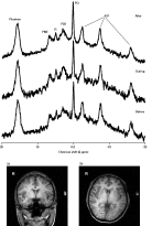 Typical 51.73 MHz 31P spectra. Shown are example spectra from before, during and after conditions (n = 13, active transcranial direct current stimulation). Spectra were acquired with a 10 cm surface coil positioned on the left temporal lobe (a, coronal and b, axial view) using a pulse and collect sequence with a sech pulse centred 300 Hz to high frequency of the resonance from β-adenosine triphosphate (ATP), with TR = 2 s, bandwidth 3500 Hz. The fiducial marker, located in the centre of the coil, can be seen on the left side of the images. Spectra in this diagram have been Fourier transformed with 8 Hz exponential multiplication. PME, Phosphomonoesters; Pi, inorganic phosphate; PDE, phosphodiesters; PCr, phosphocreatine.