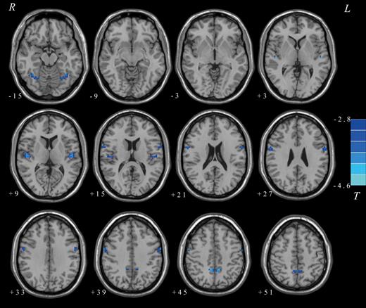 Differences in voxel-based homotopic connectivity (VMHC) between patients with adolescent-onset schizophrenia (AOS) and healthy controls. The color bar represents the t values of the VMHC group analysis.