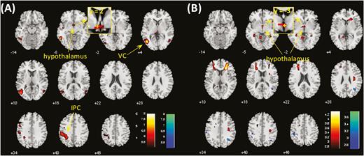 (A) Brain regions showing differences between cocaine and food cue-induced activation in cocaine-dependent participants (CD) at voxel P < .001. Clusters meeting cluster-level P < .05 whole-brain corrected for familywise error of multiple comparisons or P < .05 familywise error corrected for the hypothalamus mask are summarized in Table 2. Hot color represents clusters showing higher responses to cocaine vs neutral cues as compared with food vs neutral cues, and blue color represents clusters of the opposite contrast. (B) Hypothalamus showed differences in food cue-induced activations between CD and healthy controls (HC) at voxel P < .001 and P < .05 familywise error corrected for the hypothalamus mask. IPC, inferior parietal cortex; VC, visual cortex. The insets showed coronal sections of the brain to highlight the location of the hypothalamic cluster, with “+” indicating the location of voxel peak.