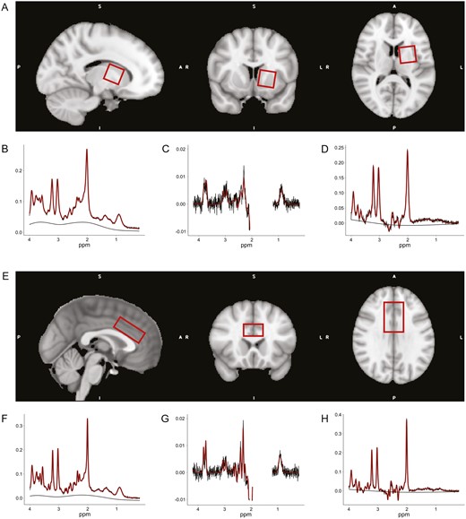 Exemplary position of the proton magnetic resonance spectroscopy (MRS) volume of interests (VOIs) in Montreal Neurological Institute (MNI) space and representative spectra from one participant. (A) Placement of the VOI in the left striatum (30 × 30 × 30 mm3). The VOI was rotated towards midline in axial plane and in anterior direction in sagittal plane, to cover as much as possible of the caudate nucleus and the putamen, while avoiding any parts of the ventricles. (B–D) Exemplary spectra of the left striatum from 1 participant with full width at half maximum (FWHM) = 9.76 Hz. (B) PRESS spectra with signal-to-noise ratio (SNR) = 28. (C) MEGA-PRESS difference (MEGAdiff) spectra with SNR = 19. (D) MEGA-PRESS OFF subresonance (MEGAoff) spectra with SNR = 25. (E) Placement of the VOI in the anterior cingulate cortex (ACC) (40 × 30 × 20 mm3). The VOI was positioned on top of the corpus callosum, centered at midline, and translated as well as rotated in the anterior direction of the sagittal plane, such that the anterior edge of the VOI was above the most anterior part of the corpus callosum genu. Hence, including most parts of the dorsal ACC. (F-H) Exemplary spectra of the ACC from 1 participant with FWHM = 6.59 Hz. (F) PRESS spectra with SNR = 48. (G) MEGAdiff spectra with SNR = 28. (H) MEGAoff spectra with SNR = 36. The smooth black lines represent the baseline model determined by LCModel.