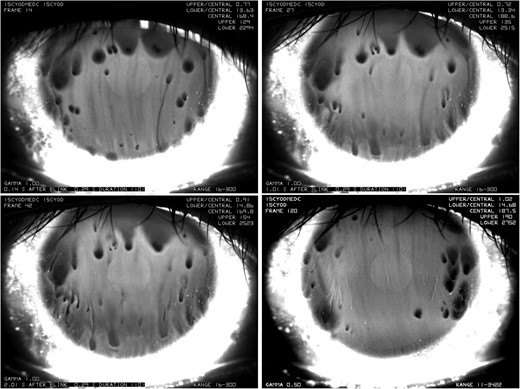 Time sequence of spot breakup (from the left to the right, from the top to the bottom). A dark spot forms 0.14 s after the first blink. The dark region then spreads downwards with unmoved dark center in the following two images 1.01 s and 2.01 s after first blink, resp. The lower right image shows that after the second blink, dark spots form again after 0.14 s in different locations.