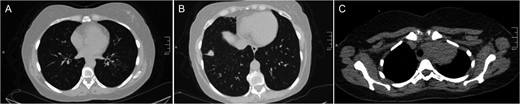Examples of computed tomography images. (A) bilateral tree-in-bud pattern most prominent in lower lobe of left lung highly suggestive of active TB; (B) lobulated solid mass with spiculated margins in anterior segment of right lower lung highly suggestive of lung cancer; (C) soft tissue density in left lung apex invading upper mediastinum suggestive of pancoast tumor.