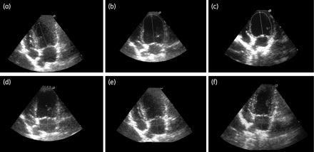LVDV (a, b and c) and LAV (d, e and f) performed on echodopplercardiographic heart images of mongrel dogs after 18 months of T. cruzi infection (12 months post-treatment with benznidazole). (a and d) Non-infected dog. (b and e) Infected non-treated dog. (c and f) Infected treated dog.