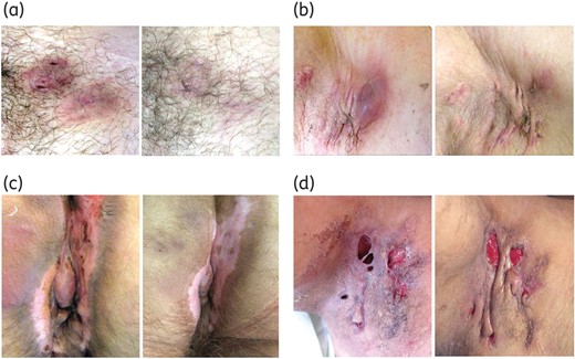 Clinical efficacy of ertapenem in patients with severe HS. Left and right panels show HS areas before and after a 6 week course of ertapenem. (a) Clinical remission of two Hurley stage 1 lesions of the pubis. (b) Axillary Hurley stage 2 area. After ertapenem, hypertrophic scars became soft and painless with progressive disappearance of erythema and purulent discharge. (c) Anal cleft (Hurley stage 3 area). At week 6, lesions were soft, pale and stopped suppurating. (d) This patient had a Hurley stage 3 lesion of the right axilla with dermal necrosis. After ertapenem, there was no suppuration and granulation tissue formation was visible. This figure appears in colour in the online version of JAC and in black and white in the print version of JAC.