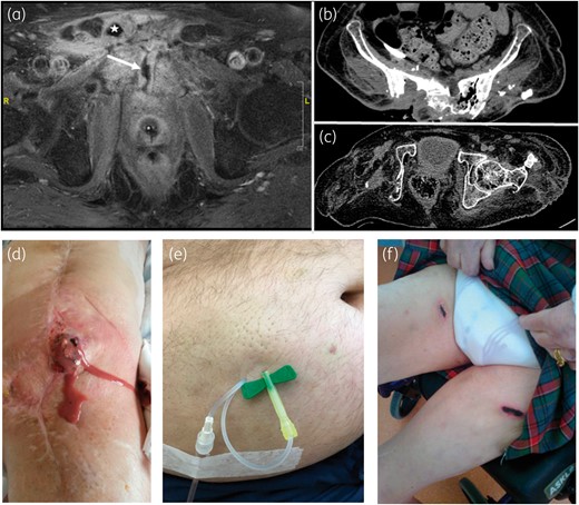 (a) Post-operative pubic CO on T1-weighted MRI after gadolinium injection and fat saturation, showing pubic symphysis abscess (star) with urethral fistula (arrow) in Patient 3, who was previously exposed to radiation and was treated with only antibiotics (no surgery). (b) Sacral CO with gas shown on a CT scan of Patient 4, who was previously exposed to radiation and was treated only with antibiotics (no surgery). (c) Relapsing right acetabular osteomyelitis on a CT scan, despite curettage and disarticulation following recurrence of native hip infection in a paraplegic patient (Patient 9, treated only with antibiotics). (d) Purulent discharge in Patient 10 with chronic relapsing prosthetic knee infection (previously treated by two-stage exchange with implantation of knee arthrodesis and soft tissue flap), treated here by debridement, implant retention and sc PSAT, with favourable outcome. (e) Orange-peel aspect of the skin without skin necrosis following gravity infusion (30–45 min) of 2 g of ceftazidime via a butterfly needle. (f) Necrosis after repeated direct (a few seconds) injections of 2 g of ceftriaxone (2–5 mL). This figure appears in colour in the online version of JAC and in black and white in the print version of JAC.
