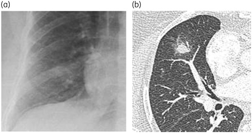 Chest X-ray (a) and axial CT slice (b) in a patient with invasive aspergillosis. Note the much higher value of the axial CT scan compared with the X-ray, perfectly demonstrating a macronodule with a halo sign at the level of the middle lobe. Such an aspect is very suggestive of the diagnosis in a specific context.
