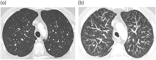 Chronic disseminated candidosis in a patient suffering from AML under salvage chemotherapy (a and b). Lung involvement appearing as multiple nodules is much better assessed by using the maximum intensity projection (suppress CR) post-processing tool (b). This tool, which consists of projecting the voxel with the highest attenuation value on every view throughout the volume onto a 2D image, improves the detection of pulmonary nodules in this setting. There was an associated hepato-splenic involvement (not shown).