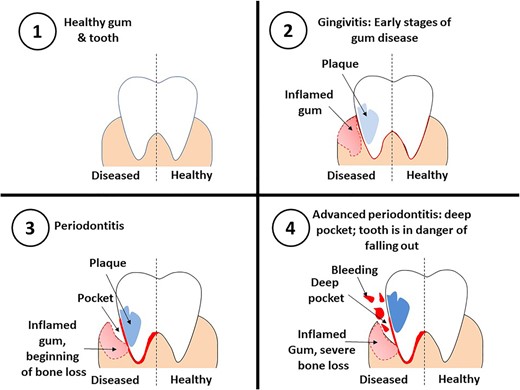 Steps for periodontal disease development.