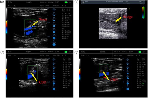 Lithogenesis in each group of experimentally raised rats. The arrow points to the powerful echo in the common bile duct (a). The arrow in (b) points to sporadic, dot-like, loud echoes in the common bile duct. (c, d) The common bile duct has good ultrasound transmission.