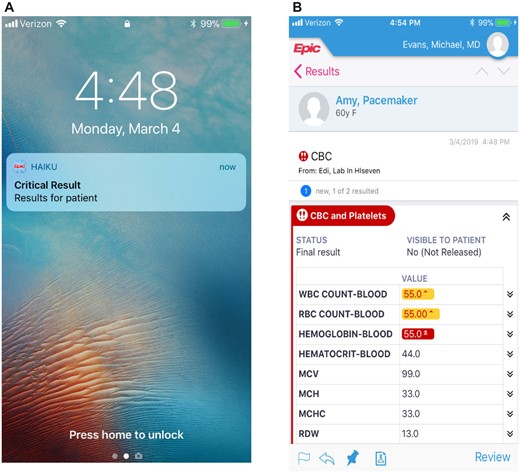 A, An example of how the push notification alert is sent to the clinician mobile device. B, When the critical lab is selected, a screenshot of an example lab that is viewed. The clinician then selects “review” to acknowledge the lab. This will also populate in the in-basket which can be reviewed or “deferred” in Epic. @2023 Epic Systems Corporation.