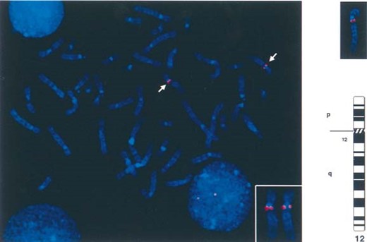 DAPI‐counterstained chromosomes in metaphase showing the location of BAC 325‐C‐22 (which contains the VDR gene) on the most centromeric part of the long arm of chromosome 12. The two chromosome 12 homologs are identified by the positive α‐satellite signals (green) (see enclosed panel). In the right upper panel, examples of chromosome 12 color images which were converted to black and white “G‐band” images to show the relative position of the probe to the centromeric end of the long arm of chromosome 12. This region is identified as 12cen‐q12.