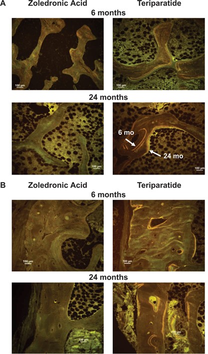 Tetracycline labels in (A) cancellous bone and (B) cortical bone, showing endocortical, intracortical, and periosteal surfaces at 6 and 24 months. Note extensive labeling on all bone surfaces in the TPTD group compared with few labels in the ZOL group. (A) In the lower right image, the labels administered at 6 and 24 months can both be seen, allowing visualization of new bone laid down in the intervening 18 months. (B) In the upper right image, note the smooth cement line underlying the convex packet of new bone on the endocortical envelope. This suggests that this bone was formed by modeling‐based, rather than remodeling‐based, formation. Further, in the lower right image, there is a Haversian system that was in the formation phase of the cycle at 6 months, but which is closed at month 24.