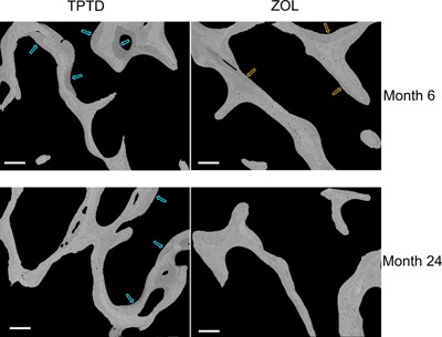 Examples of qBEI images of cancellous bone from paired biopsy samples. qBEI images from one TPTD‐ and one ZOL‐treated patient; brighter pixels indicate higher mineral content. For TPTD, low mineralized bone packets (blue arrows) at both 6 and 24 months suggest recently formed bone matrix. For ZOL, at 6 months bone packets with the lowest mineral content (orange arrows) have greater mineralization versus TPTD treatment. Scale bars = 250 μm.