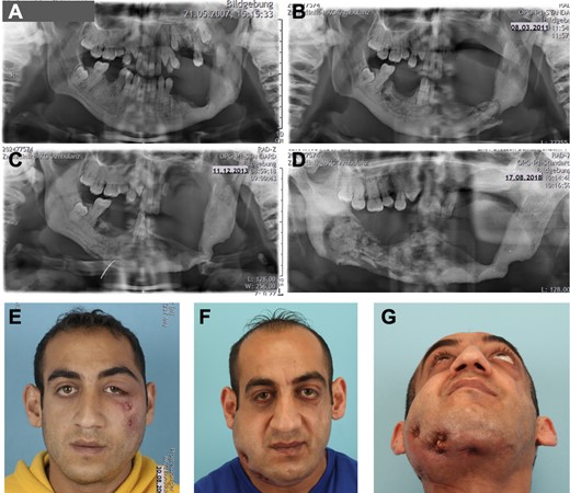 Craniofacial phenotype. (A–D) Panoramic X‐ray of the jaws. (A) Status post teeth removal in left mandible and sclerosing bone transformation. (B) After 4 years, loss of teeth in left upper jaw and mandible, pathologic fracture of the left mandible. (C) Spontaneous bone healing within two years, after intermittent sequester removal. (D). Five years later, progressive bone necrosis and sequester formation of right mandible resulting in loss of all teeth in lower mandible. (E) Initial presentation at 23 years of age with infraorbital fistulas due to necrotic maxillary bone. (F,G) Presentation at 34 years of age with perimandibular and submandibular fistulas caused by multiple sequestra of the right mandible.