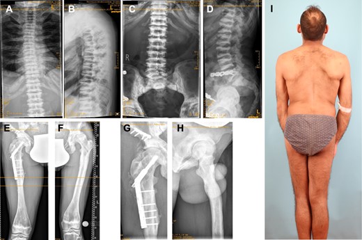 Osteopetrotic changes in the axial and appendicular skeleton. (A) Scoliosis of cervical spine with irregular corticospongious appearance of the ribs. (B) Kyphosis, sandwich appearance of vertebrae and platyspondyly. (C,D) Lumbar spine and sacroiliac joint revealing sclerotic sandwich vertebrae. (E) Osteosynthetic material after right‐sided pathologic femur shaft fracture. (F) Diaphyseal thickening and metaphyseal modeling defect of femur. (G) Osteosynthesis after pathologic pelvis fracture and (H) a modeling defect of proximal femur. (I) Full‐body picture of patient's back shows kyphoscoliosis and leg asymmetry.
