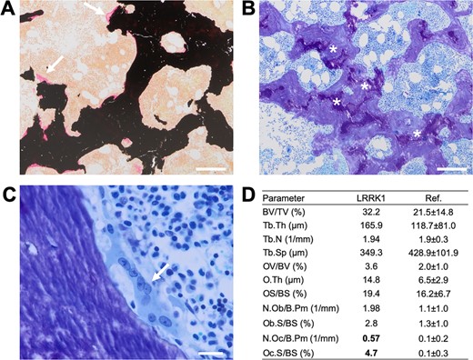 Histological characterization of an iliac crest biopsy. (A) Von Kossa/van Gieson staining showing a general increase in trabecular bone mass (primarily trabecular thickening) and no increased osteoid indices (white arrows). (B) Toluidine staining (overview) with cartilage remnants (asterisks). (C) Flat, multinucleated osteoclast (white arrow) and no visible resorption lacuna (ie, eroded surface) indicative of defective bone resorption. (D) Bone histomorphometry pointing to increased bone mass, slightly elevated osteoid levels, and a markedly higher osteoclast surface per bone surface compared to previously published age‐matched reference values.16
