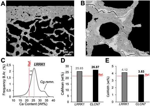Backscattered electron imaging. (A) Biopsy overview indicating hypermineralized areas corresponding to cartilage remnants. (B) Confirmation of highly mineralized bone areas at higher magnification. (C) BMDD histogram demonstrates overall high matrix mineralization, partly due to cartilage remnants (second peak). (D,E) CaMean and CaWidth are overall higher compared to reference values18 and similar to CLCN7‐related autosomal dominant osteopetrosis type II.16