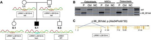 Genetic analysis. (A) Segregation of the mutation LRRK1 c.261G>A by Sanger sequencing. The index (II.1/P2) is affected and carries the mutation in a homozygous state. The clinically unaffected parents carry the mutation in a heterozygous state. (B) RT‐PCR of exons 2–6 of LRRK1 in patient‐derived osteoblasts, MSCs, and osteoclasts (P) compared to a healthy control (Ctrl) and a negative control (NC). The PCR product of the primer pairs (exon 2–6) yielded a 957‐bp product (WT). A smaller band of approximately 800 bp was detected in all cell lines carrying the LRRK1 splice site mutation indicating abnormal splicing. Sequencing of the lower band showed skipping of exon 3. (C) Schematic representation of the LRRK1 gene showing skipping of exon 3 leading to a frameshift mutation c.98_261del; p.Ala34Profs*33. MSC = mesenchymal stem cell.