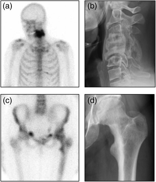 Representative images from participants with bone lesions. (A) Radionuclide bone scan image showing intense tracer uptake in cervical vertebrae 4 and 5. (B) Radiograph from the same patient showing typical features of Paget's disease with expansion and fusion of C4 and C5. The patient was asymptomatic and had no neurological abnormalites. (C) Radionuclide bone scan image showing increased tracer uptake in the upper femur on the left side. (D) Radiograph from the same patient showing coarsening of the trabecular pattern in the upper femur and cortical thickening of the medial aspect of the upper femur.
