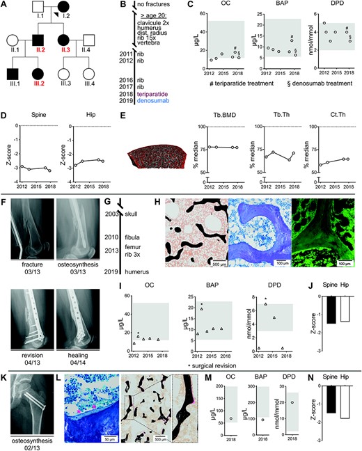 Low bone turnover in patients carrying a heterozygous WNT1‐R235W mutation. (A) Pedigree of a previously described family affected by heterozygous WNT1 mutation Arg.235Trp. The three cases, which were studied in greater detail, are indicated in red. (B) Fracture timeline and treatment history for case 1 (II.2). After initiation of specific treatment, no further fractures occurred until today. (C) Serum levels of osteocalcin (OC), bone‐specific alkaline phosphatase (BAP), and ratio of Dpd/Crea urine levels for case 1 at different time points. Age‐ and sex‐specific reference ranges are indicated in gray. Initiation of teriparatide or denosumab treatment are indicated by # and §, respectively. (D) DXA Z‐scores within osteoporotic range for spine and hip in case 1 at different time points. (E) HR‐pQCT of the distal tibia and quantification of trabecular bone mineral density (Tb.BMD), trabecular thickness (Tb.Th), and cortical thickness (Ct.Th.) revealed reductions compared with age‐ and sex‐matched reference values (median set as 100%).(28) (F) X‐rays for case 2 after femur fracture and initial surgery (upper row). Fracture consolidation was prolonged and healing was documented after surgical revision at month 13 (lower row). (G) Fracture timeline for case 2 (II.3). (H) Representative images of an undecalcified transiliac bone biopsy of case 2 (left, von Kossa/van Gieson staining; middle, toluidine blue staining; right, fluorescent micrograph after tetracycline labeling). (I) Serum levels of OC, BAP, and ratio of Dpd/Crea urine levels for case 2 at different time points. Age‐ and sex‐specific reference ranges are indicated in gray. Asterisks represent measurements in context of surgical revision. (J) DXA Z‐scores for spine and hip in case 2 within the range of osteopenia. (K) X‐ray showing an osteosynthesis in case 3 (III.2) due to traumatic proximal femur fracture at the age of 6 years. (L) Representative images of an undecalcified transiliac biopsy of case 3 obtained in context of osteosynthesis (left, von Kossa/van Gieson staining; right, toluidine blue staining). Thin trabeculae and low osteoid volume as well as flattened osteoblasts (marked by asterisks) display low turnover phenotype. (M) Serum levels at the age of 12 years of OC, BAP, and ratio of Dpd/Crea urine levels for case 3, indicating relatively low bone formation. Age‐ and sex‐specific reference ranges are shown in gray. (N) DXA Z‐scores for spine and hip in case 3 at the age of 12 years.