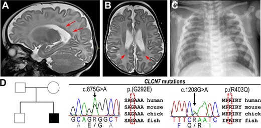 Radiologic images of an ARO patient with compound heterozygous mutations in the CLCN7 gene. (A) T2W sagittal MRI and (B) axial MRI of the head of 4‐month‐old patient with reduced brain volume and periventricular laminar subependymal heterotopias (red arrows). (C) Chest x‐ray of 7‐month‐old patient showing sclerosis and plump configuration of the ribs. (D) Pedigree of the affected family carrying the heterozygous missense mutations c.875G>A p.(G292E) and c.1208G>A p.(R403Q) in conserved regions of the CLCN7 gene. Abbreviations: ARO, autosomal recessive osteopetrosis; MRI, magnetic resonance imaging; T2W, T2‐weighted.