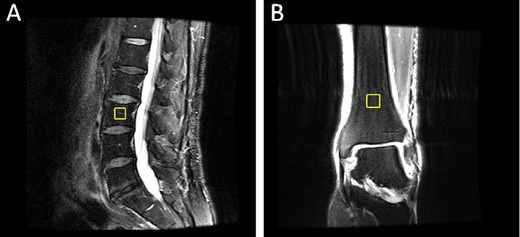 Example MRS VOI: (a)spine (sagittal view), and (b) distal tibia (coronal view).
