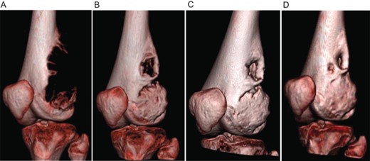 Computed tomography showing regression of the giant cell tumor of bone in patient 1. (A) before denosumab initiation, (B) 1.5 months after denosumab initiation, (C) 3 months after denosumab initiation, and (D) 8 months after denosumab discontinuation.