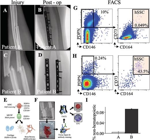 (A,C) forearm radiographs demonstrating bending wedge diaphyseal ulna fracture at injury and immediately postoperatively. (B,D) fForearm radiographs demonstrating simple fracture patterns of diaphyseal radius and ulna at injury and immediately post operatively. (E) Schematic of the human SSC lineage tree with a self renewing stem cell at the top of the hierarchy giving rise to a human bone/cartilage/stromal cell progenitor (hBCSP) and to lineage committed cartilage and bone/stromal cells (PDPN: Podoplanin). (F) Experimental workflow for SSC isolation from patient tissue. (G,H) FACS plots demonstrating isolation of SSCs from fractures immediately after surgery. (I) Frequency of hSSCS at fracture sites as percentage of non hematopoietic cells for normalization.
