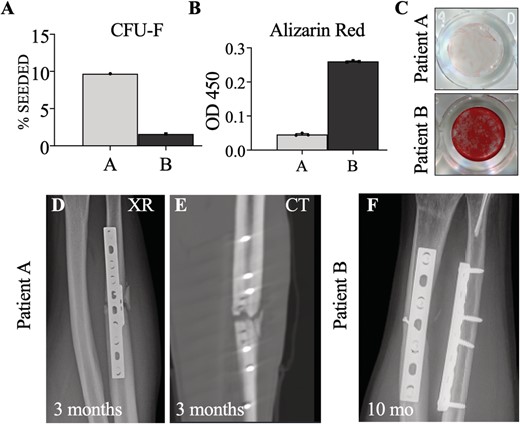 (A) Comparison of colony forming unit fibroblast (CFU F) assay between patients A and B as a percent of hSSCs cultured. (B) Alizarin red stain quantification between samples A and B run in triplicate using spectrophotometry with optical density measurement at 450 nm. (C) Qualitative comparison of alizarin red staining of hSSCs after osteogenic differentiation. (D,E) plain radiographs (XR) and computed tomography (CT) at 3months demonstrating absence of callus formation in patient A (F). Ten month radiographs of patient B demonstrating healed fractures.