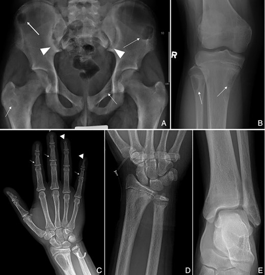Anteroposterior (AP) radiograph of the pelvis (A) and right knee (B): Multiple well defined, lytic lesions (arrows) seen throughout the pelvis and proximal tibia and fibula with thin sclerotic borders compatible with brown tumors. Subchondral resorption at the sacroiliac joints with widening and adjacent sclerosis is more pronounced on the iliac side (arrowheads). AP radiograph right hand (C): Subperiosteal resorption along the radial aspects of the middle phalanges (arrows), and resorption of the distal phalangeal tufts consistent with acro osteolysis (arrowheads). Subphyseal resorption along the distal ulnar metaphysis resulting in physeal widening (curved arrow). AP radiograph of the left wrist (D): Site of HRpQCT distal radius scan, and left ankle (E): Site of HRpQCT distal tibia scan.