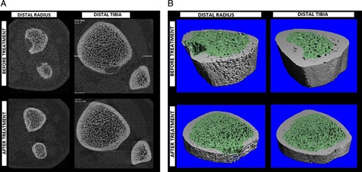 Comparison of distal radius and distal tibia bone quality before and after treatment within (A) 2D transaxial slices and (B) 3D renderings of CT segmentations. Both the distal radius and tibia showed compaction of trabecular bone with tighter separation between trabeculae. The distal radius showed more cortical porosity before treatment, which resolved along with the trabecular compaction to some degree after therapy. Regularity of the trabecular distribution is shown to have improved following therapy. Osteolytic lesions are apparent in both 2D and 3D representations, and the resolution after surgery and treatment is notable.