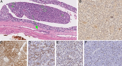 Histopathology of parathyroid carcinoma. The tumor showed increased mitotic activity as well as a focus of angioinvasion (arrows) characterized by intravascular tumor cells admixed with thrombus (A). Green circles highlight mitotic figures in this photomicrograph (A). The tumor showed global loss of parafibromin expression, while the endothelial cells remained positive (B). The tumor cells were also variably positive for PGP9.5 (C) and galectin 3 (D), and showed reduced expression for p27 (E). While the tumor displayed intratumoral proliferative heterogeneity, the MIB 1 labeling index was as high as 25.45% in hot spots (F).