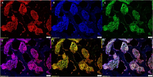 Staining with lectin (A), DAPI (B), and VEGFR2 (C) ensured there was sufficient similarity between lectin and VEGFR2 yet enough selectivity to differentiate between DAPI and lectin-stained tissue. The lectin and DAPI composite (D) demonstrates that lectin has specificity to vascular tissue and the lectin and VEGFR2 composite (E) demonstrates specificity of lectin binding to tissue expressing the VEGF2 receptor. Overlays of staining in images (A–C) are depicted in image (F).