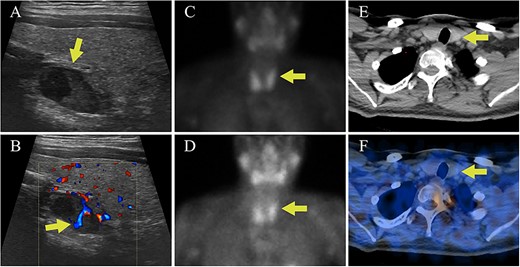 Case I parathyroid localization studies. (A) Thyroid US showed a heterogenous hypoechoic lesion posterior to the left thyroid lobe measuring 0.9 cm deep × 0.9 cm wide × 1.5 cm long (arrow, sagittal view). (B) Internal vascularity within the lesion was evident using doppler imaging (arrow, sagittal view). (C) On technetium-99m sestamibi scintigraphy physiologic uptake or the radiotracer was seen in the thyroid gland on the immediate images (arrow). (D) One hour delayed sestamibi images showed poor washout of radiotracer (arrow) but no areas of focal radiotracer retention. (E, F) No focal areas of uptake were observed on SPECT/CT images in the region correlating with the lesion identified on US (arrows).