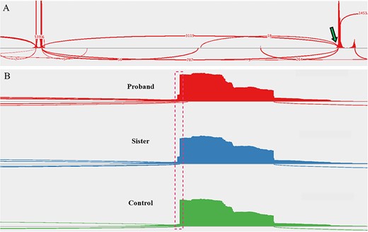 Sashimi plots drawn from RNA-sequencing data. (A) A sample of the proband’s peripheral blood demonstrated the native splice site (arrow, ~80% use) and introduction of a cryptic splice site (~20% use). Read densities at splice junction sites are shown; junction reads are plotted as arcs. (B) A zoomed-in image of the splice junction site reveals the insertion of two intronic nucleotides (dashed box) in the affected family members but not in an unaffected control patient (proband, (top); sister, (middle); control, (bottom)).