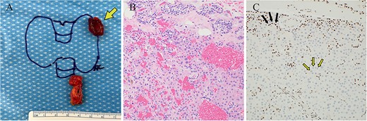 Case 1 left upper parathyroideçtomy pathology. (A) Gross pathology following surgical parathyroid exploration in which the left upper parathyroid gland (arrow) and a portion of the thymus were removed. The excised parathyroid gland measured 1.5 × 1.2 × 0.7 cm and weighed 0.95 g. (B) H&E-stained sections revealed hypercellular parathyroid parenchyma consistent with a parathyroid adenoma. (C) Immunohistochemical staining for parafibromin revealed focally weak to negative nuclear expression in lesional cells (two-toned arrows) with retained staining in surrounding cells (internal positive control, solid arrows).