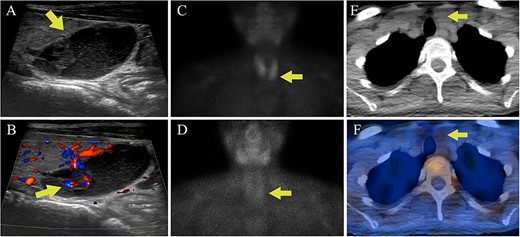 Case 2 parathyroid localization studies. (A) Thyroid US revealed a left inferior thyroid lobe lesion measuring 1.5 cm deep × 1.6 cm wide × 2.0 cm long (arrow, sagittal view). The lesion had a complex cystic and solid appearance with layering internal debris. (B) The solid component of the lesion demonstrated vascularity (arrow, sagittal view with Doppler). (C) Sestamibi scintigraphy showed physiologic radiotracer uptake of the thyroid gland on the immediate images (arrow). (D) One hour delayed sestamibi images showed radiotracer washout without areas of focal sestamibi retention (arrow). (E) The lesion observed on thyroid US correlated with a hypoattenuating lesion posterior to the left thyroid lobe on the CT scan that was done for (arrow). (F) The hypoattenuating lesion did not have increased radiotracer uptake on the fused SPECT/CT image (arrow).