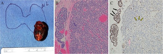 Case 2 left lower parathyroidectomy pathology. (A) The specimen measured 2.5 × 1.5 × 1.2 cm, weighed 2.8 g, and contained a cystic structure consisting of dark brown fluid. (B) H&E-stained sections displayed hypercellular parathyroid parathyroid with associated areas of fibrosis and cyst formation. No significant cytologic atypia, mitotic activity, or angioinvasion was identified. (C) Immunohistochemical staining for parafibromin revealed negative nuclear expression in the lesional cells (two-toned arrows) and retained staining in surrounding cells (internal positive control, solid arrows).