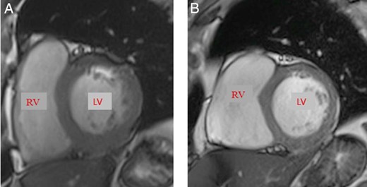 Cardiac magnetic resonance.