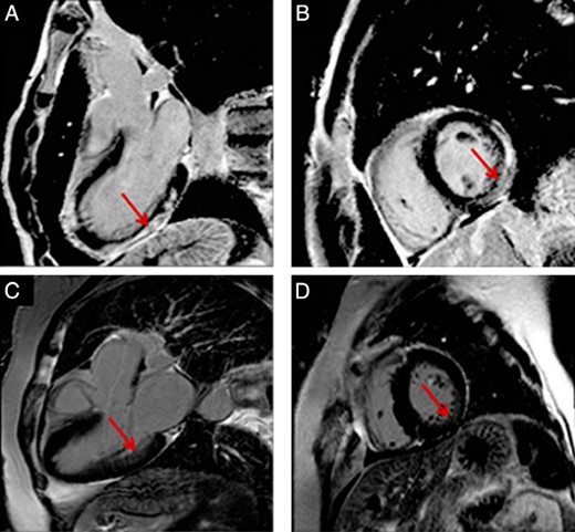 Cardiac magnetic resonance.