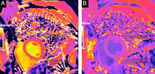 T1 mapping in a 48-year-old man.