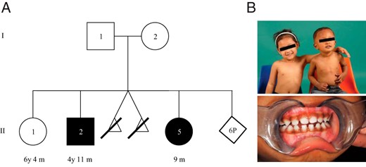 A, Pedigree of FGD family, filled symbols representing affected individuals. B, Upper panel, proband II:2 (on the right) with his unaffected sibling II:1. Lower panel, note the increased skin and gum pigmentation of the proband.