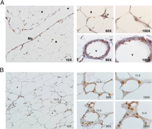 Immunohistochemical detection of PTHrP (in brown) in VAT (A) and in SAT (B) from MO-L-IR subjects (BMI = 45 kg/m2).